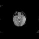 Perinatal thrombosis of the left middle cerebral artery, MCA: MRI - Magnetic Resonance Imaging